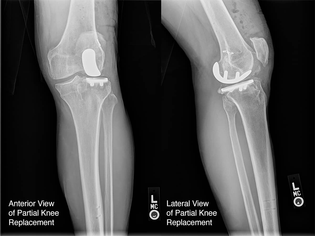 delaying-knee-joint-replacement